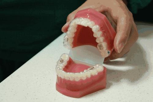 成人牙齿矫正要多久，威斯尼斯人www.5845cc博士告诉你